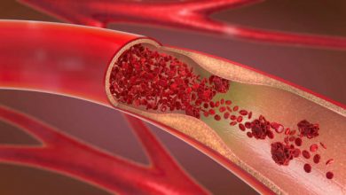Photo of Hardened Arteries: 7 Ways To Reverse It