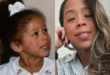 Photo of I Did An Eczema Clinical Trial and Found Healing and Purpose