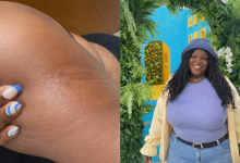 Photo of Living with CSU: “I Felt Like My Body Was Betraying Me” – BlackDoctor.org
