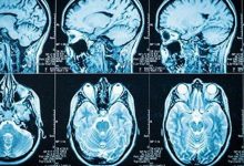Photo of Different Types of Brain Tumors: What They Are, How They Present and What To Expect – BlackDoctor.org