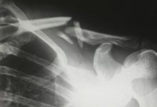 Photo of What Types of Injuries May Support a Personal Injury Settlement?