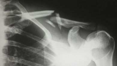 Photo of What Types of Injuries May Support a Personal Injury Settlement?